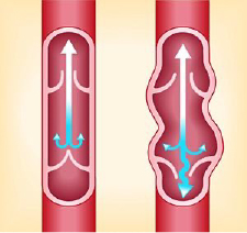 Illustration of normal and affected vein